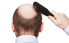 Rụng tóc ở nam giới là dấu hiệu bệnh gì?