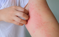 Xử trí và phòng ngừa sẩn ngứa do bọ chét cắn