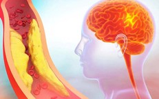 5 dấu hiệu cảnh báo thiếu máu não do hẹp động mạch cảnh