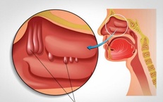 Nghẹt mũi, khó thở là biểu hiện của bệnh gì?