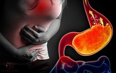 Huyệt vị hỗ trợ chứng trào ngược dạ dày