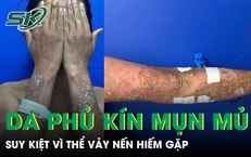 Da phủ kín mụn mủ, nữ bệnh nhân 28 tuổi suy kiệt vì thể vảy nến hiếm gặp