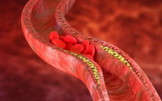 Thay đổi lối sống giúp kiểm soát cholesterol cao, giảm nguy cơ bệnh tim mạch