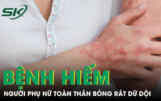 Căn bệnh hiếm khiến người phụ nữ sốt cao, toàn thân đỏ rực và bỏng rát dữ dội 