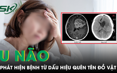 Liên tục quên tên đồ vật quen thuộc, người phụ nữ phát hiện khối u não nguy hiểm 
