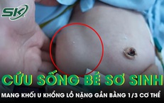 Cứu sống bé sơ sinh mang khối u khổng lồ nặng gần bằng 1/3 cơ thể
