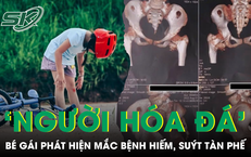 Bé gái cứng khớp suốt 2 năm sau cú ngã nhẹ, bác sĩ phát hiện mắc bệnh 'người hóa đá'