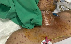 Nam bệnh nhân 32 tuổi bị biến chứng thuỷ đậu phải thở máy kéo dài 