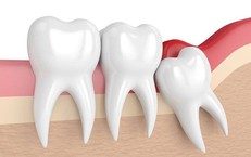 Răng số 8 mọc lệch không đau có cần nhổ?