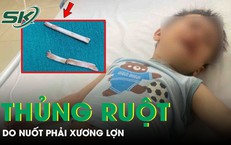Hai trẻ bị thủng ruột, viêm phúc mạc do nuốt phải xương lợn