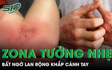 Zona tưởng nhẹ bất ngờ lan rộng khắp cánh tay khiến du khách trẻ nhập viện 