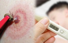 Suy đa tạng do mò đốt, đặc trưng của bệnh sốt mò cần biết
