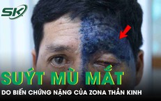 Người đàn ông 54 tuổi suýt mù mắt do biến chứng nặng của zona thần kinh
