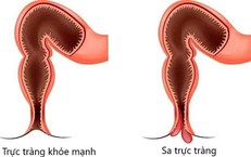 Sa trực tràng ở trẻ em có nguy hiểm?