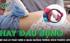 Nhiều lần đau bụng thoáng qua, bé gái 6 tuổi phát hiện u quái buồng trứng kích thước lớn