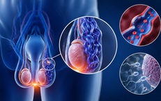 Tự kiểm tra giãn tĩnh mạch thừng tinh tại nhà bằng cách đơn giản