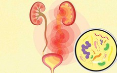 Nhiễm khuẩn tiết niệu có biểu hiện như thế nào?