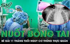 Nuốt phải bông tai kim loại, bé gái 11 tháng tuổi đối mặt nguy cơ thủng thực quản