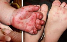 Tay chân miệng tăng nhanh ở Khánh Hòa, bác sĩ khuyến cáo người dân không chủ quan