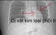 Ho không dứt, bác sĩ phát hiện cán thìa inox mắc trong phế quản bệnh nhân