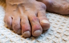 Hạt tophi ở người bệnh gout khi nào cần xử trí?
