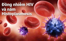 Đồng nhiễm HIV và nấm Histoplasmosis: Phát hiện sớm để giảm nguy cơ tổn thương phổi và tử vong