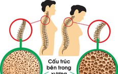 Tuổi nào bắt đầu bị loãng xương và cách phòng bệnh hiệu quả từ sớm