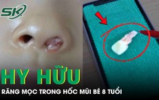 Răng mọc trong hốc mũi bé gái 8 tuổi