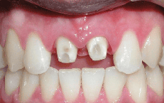 Trước khi mài răng để bọc sứ, đừng quên 4 câu hỏi này