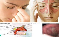 Viêm mũi xoang mùa mưa: Đừng chủ quan với những cơn nghẹt mũi kéo dài