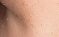 Vì sao mụn thịt thường mọc quanh mắt, xử trí thế nào?