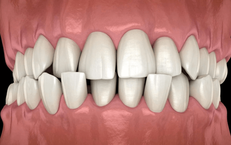 10 dấu hiệu cần chỉnh nha sớm ở trẻ em, đừng đợi đến khi con mọc đủ răng mới đi khám