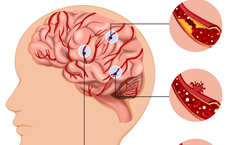 Những yếu tố làm tăng nguy cơ xuất huyết não