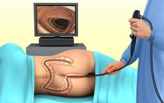 Trước và sau khi nội soi đại tràng cần lưu ý gì?