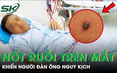 Người đàn ông nguy kịch từ nốt ruồi nhỏ, bác sĩ chỉ mặt dấu hiệu "chí mạng" nhiều người bỏ qua