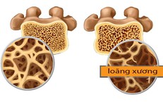 Thói quen tốt giúp phòng ngừa loãng xương sau mãn kinh
