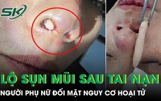 Nâng mũi xong gặp tai nạn, người phụ nữ đối mặt nguy cơ hoại tử mũi