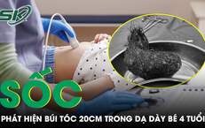 Bé gái 4 tuổi đau bụng triền miên, bác sĩ sốc khi lấy ra búi tóc dài gần 20cm trong dạ dày