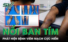 Nổi nốt đỏ tím khắp người, nam thanh niên phát hiện mắc bệnh viêm mạch cực hiếm 