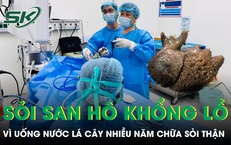 Uống nước lá cây nhiều năm người đàn ông nuôi khối sỏi san hô khổng lồ trong thận 