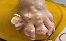 Nhiễm khuẩn huyết do vết loét hạt tophi: Biến chứng chết người từ thói quen của người bệnh gút
