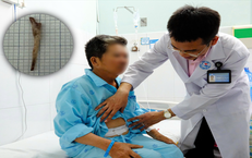 Người đàn ông suýt mất mạng vì mảnh xương đâm thủng dạ dày