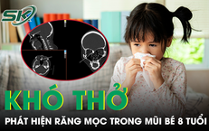 Bác sĩ phát hiện nguyên nhân bất ngờ khiến bé gái 8 tuổi nghẹt mũi nhiều năm