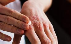 Cần làm gì khi nghi ngờ bị viêm da tiếp xúc?