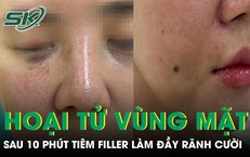 Cô gái 29 tuổi hoại tử vùng mặt sau 10 phút tiêm filler làm đầy rãnh cười 