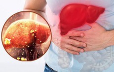 7 dấu hiệu tổn thương gan 