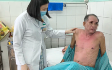 Dị ứng thuốc nhỏ mắt, người đàn ông bị hoại tử thượng bì nhiễm độc nguy kịch