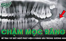 Răng nanh chậm mọc, bé trai bất ngờ phát hiện u răng sâu trong xương hàm