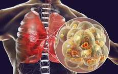 Nhận biết sớm dấu hiệu viêm phổi ở trẻ