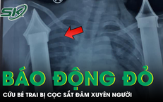 Bé trai 6 tuổi nguy kịch do cọc sắt xuyên từ bụng xuống tầng sinh môn